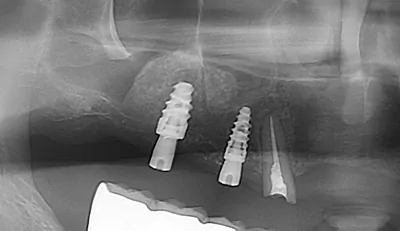 症例サイナスリフト