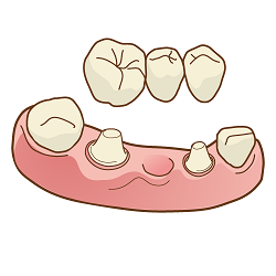 両隣の歯を支えにして人工の歯を補う方法