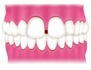 空隙歯列(すきっ歯)