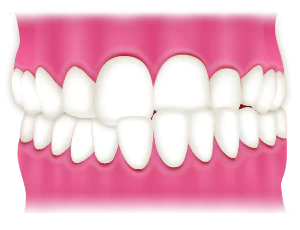 交叉咬合(かみ合わせのずれ)