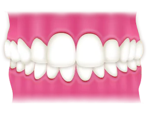 過蓋咬合(オーバーバイト)