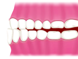 下顎前突(受け口)