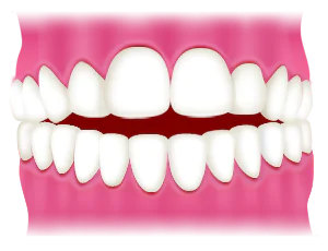 開咬(オープンバイト)