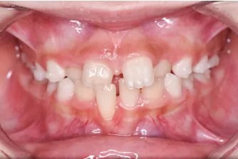 インビザライン・ファースト治療前