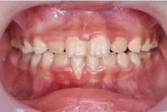 インビザライン・ファースト治療後