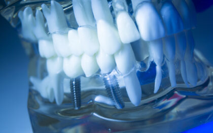 インプラントの症例