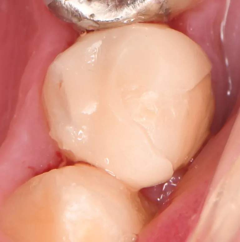 CAD/CAMインレー(保険)