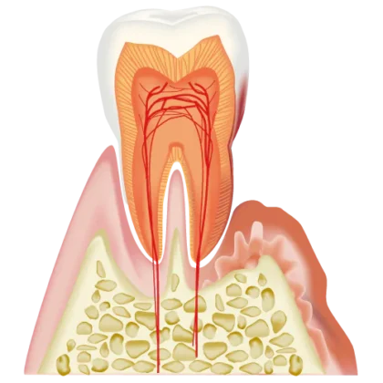 歯周組織再生療法とは？