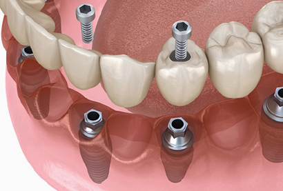総入れ歯や重度の歯周病で悩んでいる方へ