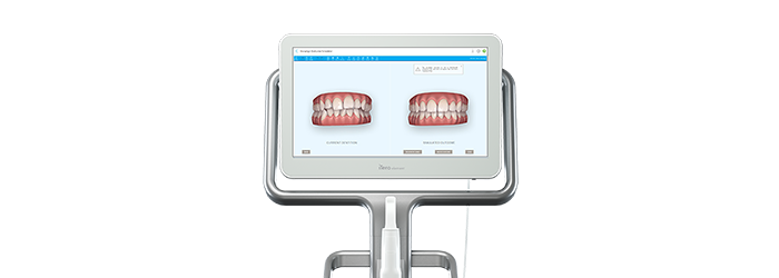 口腔内スキャナーiTero