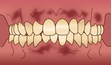 歯ぐきの黒ずみを改善して健康的な歯ぐきの色へ