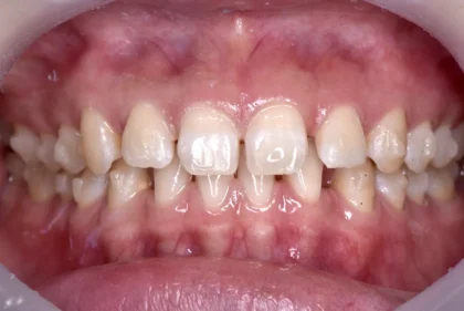 空隙歯列（すきっ歯）治療前