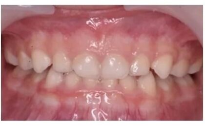 ムーシールド治療後