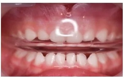 ムーシールド治療中