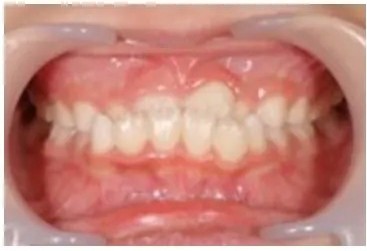 リンガルアーチ治療前