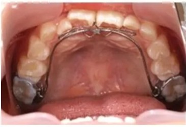 リンガルアーチ治療中