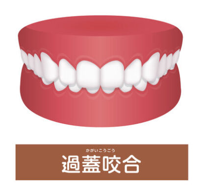 過蓋咬合