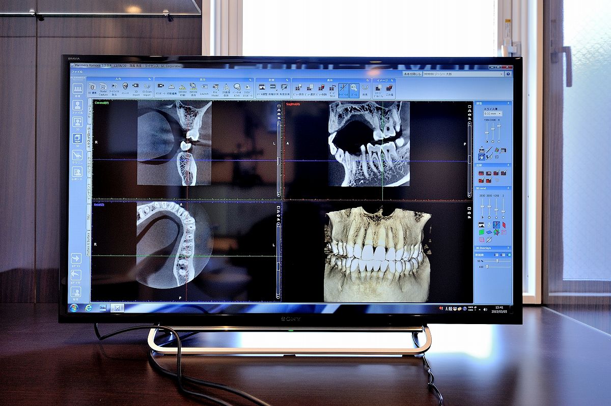 歯科用CT検査