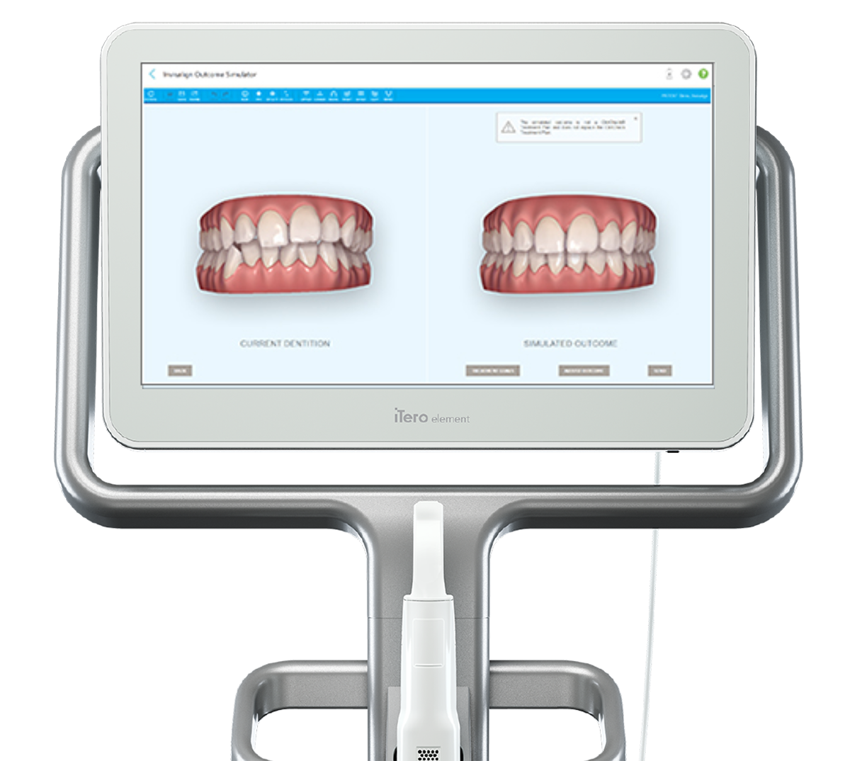 口腔内スキャナーiTeroとは