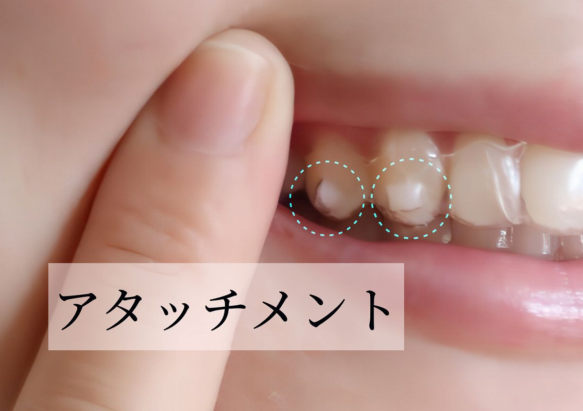 アタッチメントを設置する場合がある