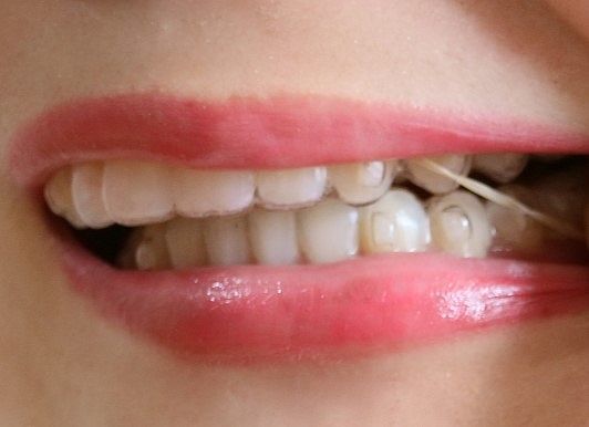 ゴムかけ（顎間ゴム）が必要になることもある