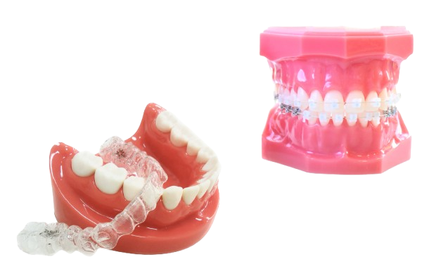マウスピースだけで難しい症例は、ワイヤーとの併用で確実に
