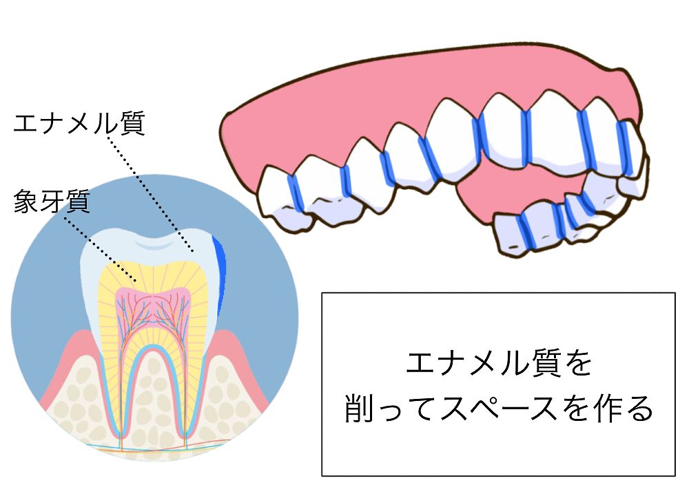 IPR（ディスキング）