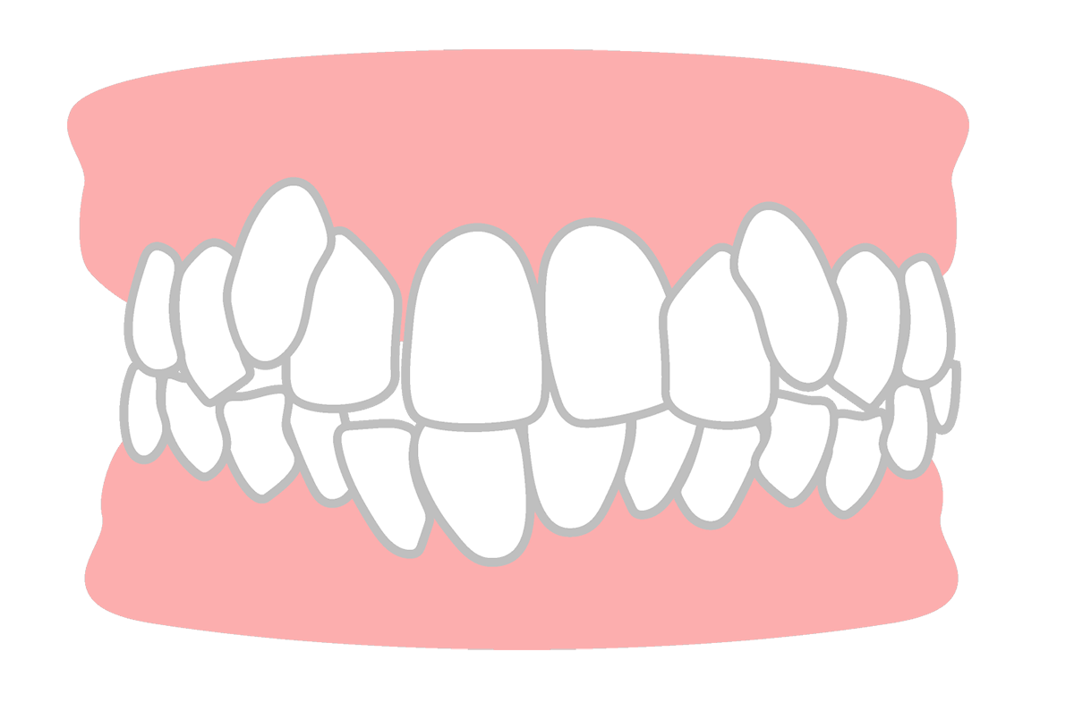 叢生(そうせい)