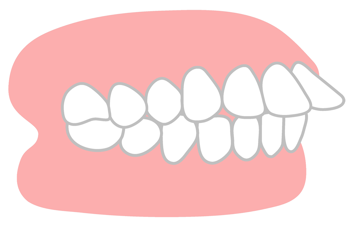 上顎前突(じょうがくぜんとつ)
