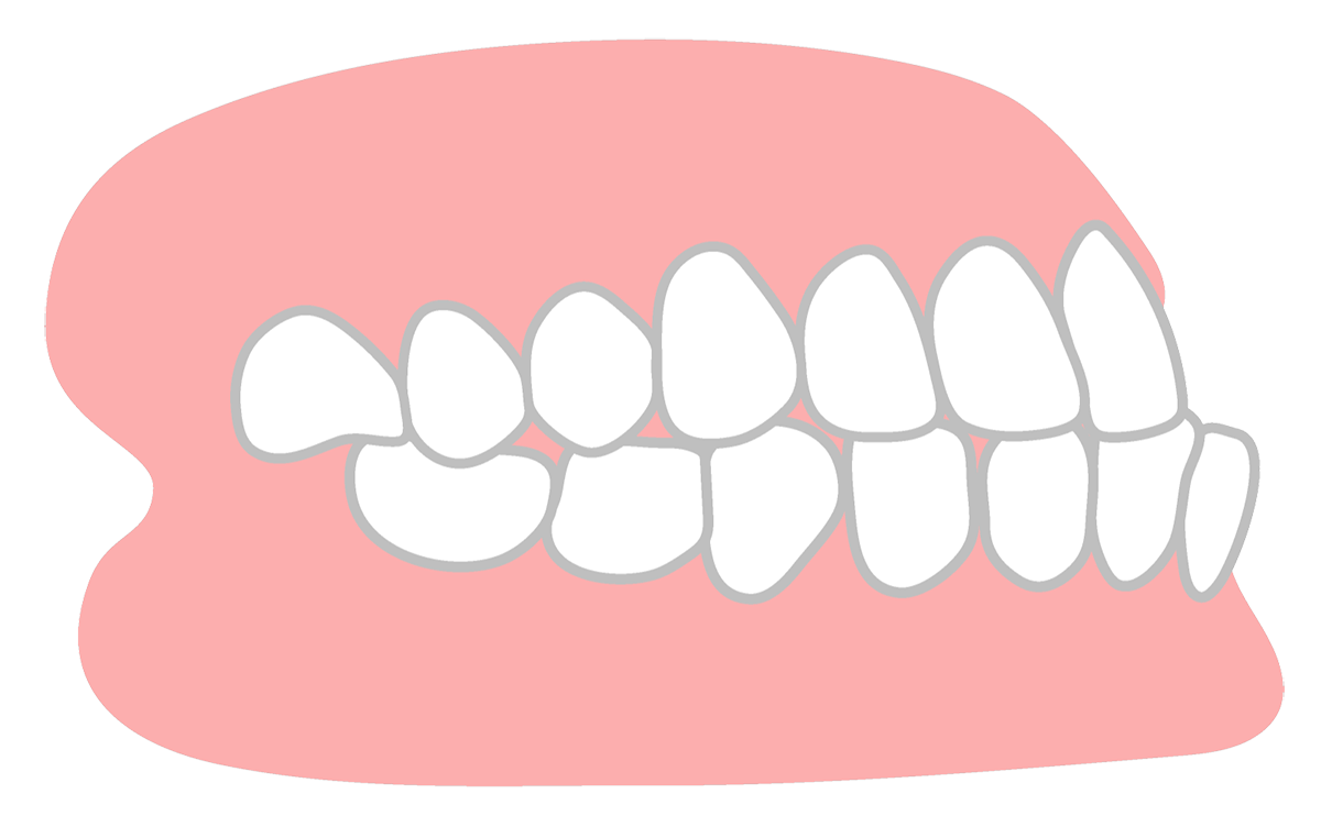 下顎前突(かがくぜんとつ)