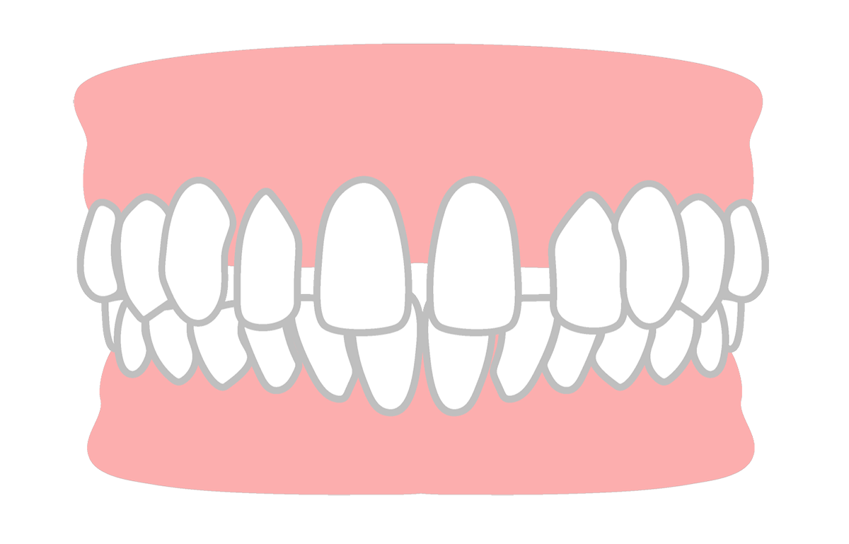 空隙歯列(くうげきしれつ)