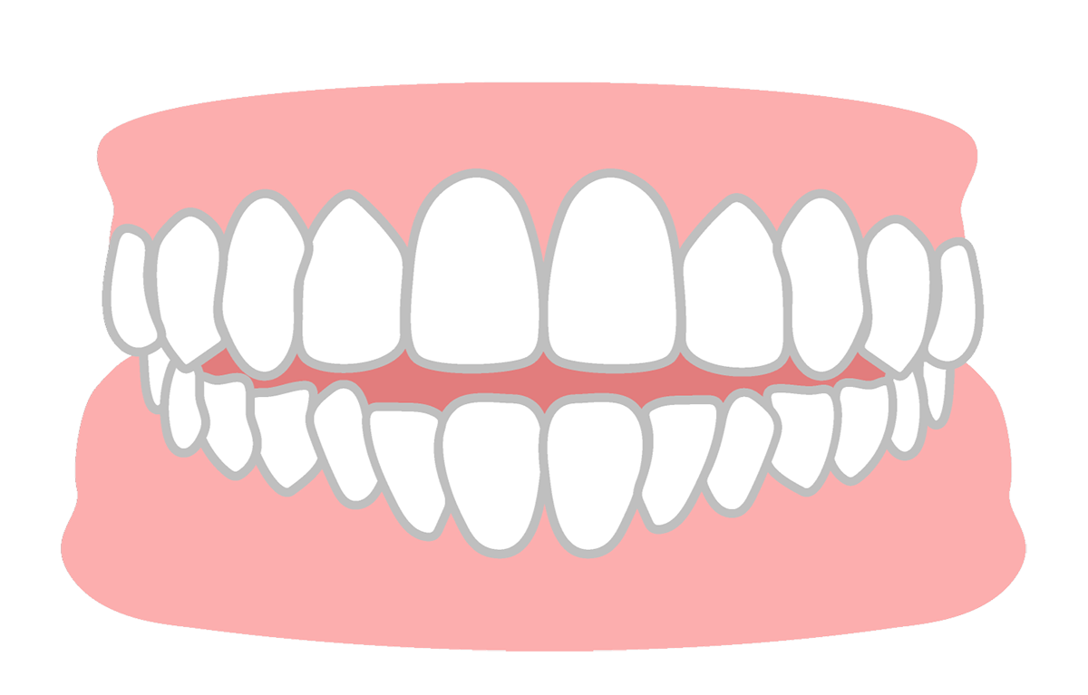 開咬(かいこう)