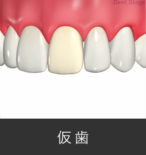 仮歯