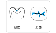 歯の溝は虫歯になりやすい