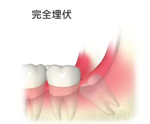 親知らずは抜いたほうがいいの？