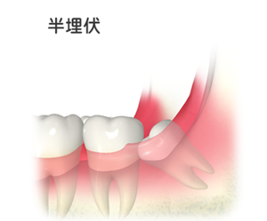 親知らずは抜いたほうがいいの？